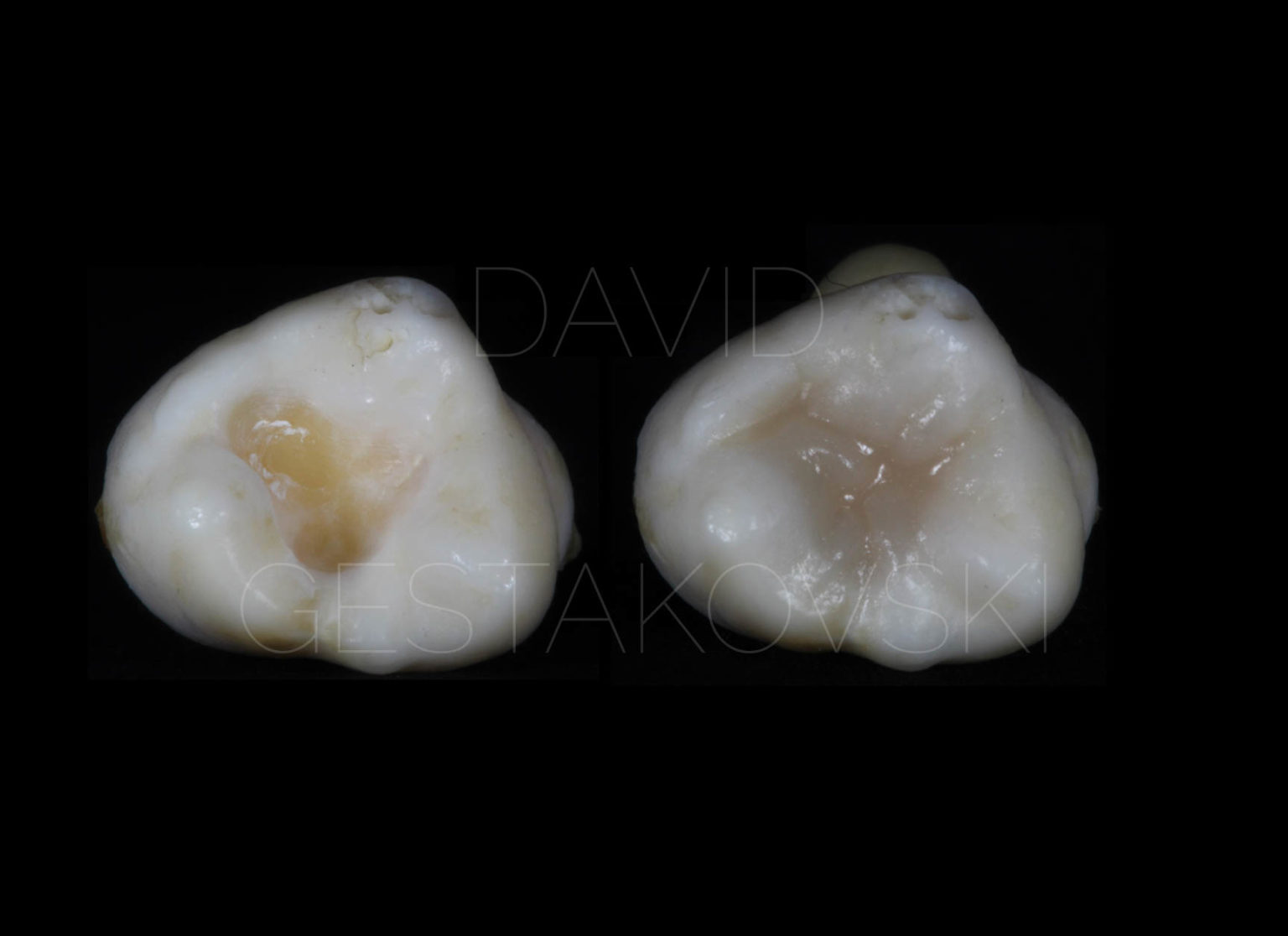 Occlusal Stamp Technique Learn Injectable Technique Online Dental