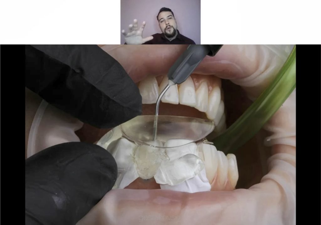 Composite Veneers Injectable Technique Masterclass Recording