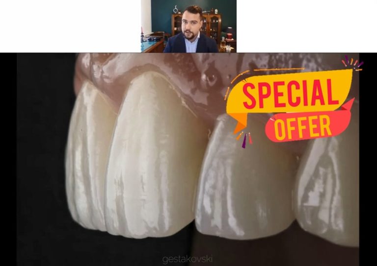 [ALL YOU CAN WATCH] Composite Veneers Masterclass + Full Mouth
