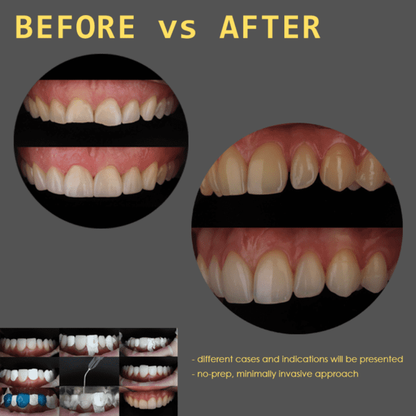 [Zagreb INTERNATIONAL – 06.06.2025.] -  Comprehensive Hands-on course: Composite veneers - Injectable technique (English language) + 8 hours theory online - Image 10