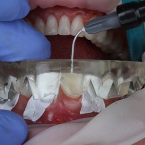 [3-in-1 ALL YOU CAN WATCH Package] Composite Veneers Masterclass + Full Mouth Rehabilitation Functional Program + Occlusal Stamp Technique - 3 MONTHS ACCESS